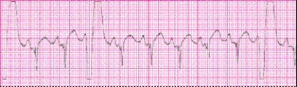 Identify the following rhythm (lead II): ____________________   