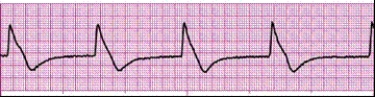 Identify the following rhythm (lead II): ____________________   