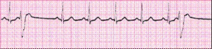 Identify the following rhythm (lead II): ____________________   