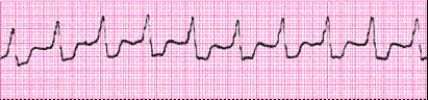 Identify the following rhythm (lead II): ____________________   