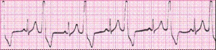 Identify the following rhythm (lead II): ____________________   