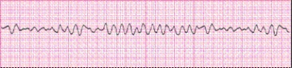 Identify the following rhythm (lead II): ____________________   