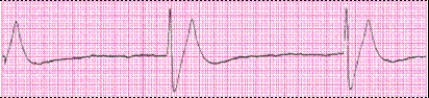 Identify the following rhythm (lead II): ____________________   