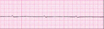 Identify the following rhythm (lead II): ____________________   