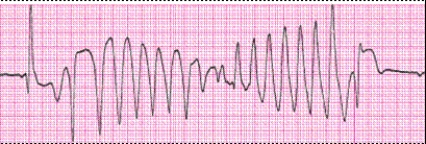 Identify the following rhythm (lead II): ____________________   