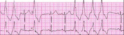 Identify the following rhythm: ____________________   
