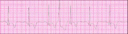 Identify the following rhythm (lead II): ____________________   