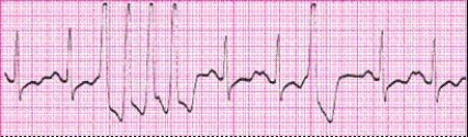 Identify the following rhythm (lead II): ____________________   