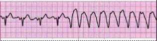 Identify the following rhythm (lead II): ____________________   