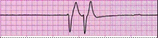 Identify the following rhythm (lead II): ____________________   