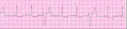 Identify the following rhythm (lead II): ____________________   