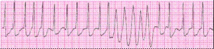 Identify the following rhythm (lead II): ____________________   