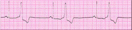 Identify the following rhythm (lead II): ____________________   