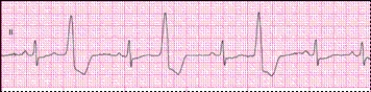 Identify the following rhythm: ____________________   