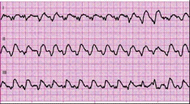 Identify the following rhythm: ____________________   