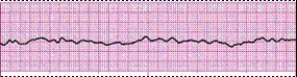 Identify the following rhythm (lead II): ____________________   
