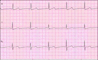 Identify the following rhythm: ____________________   