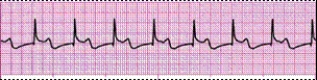 Identify the following rhythm (lead II): ____________________   