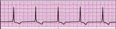 Identify the following rhythm (lead II): ____________________   