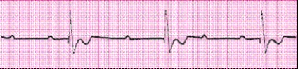 Identify the following rhythm: _________________________   