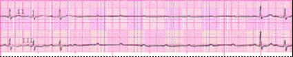 Identify the following rhythm: _________________________   