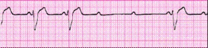 Identify the following rhythm: _________________________   