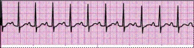 Identify the following rhythm: _________________________   