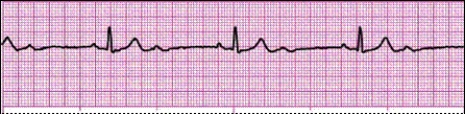 Identify the following rhythm: _________________________   