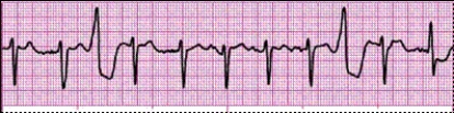 Identify the following rhythm: _________________________   