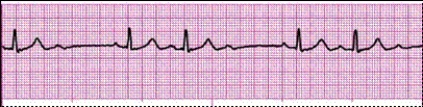 Identify the following rhythm: _________________________   