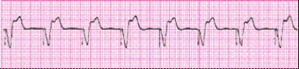Identify the following rhythm: _________________________   