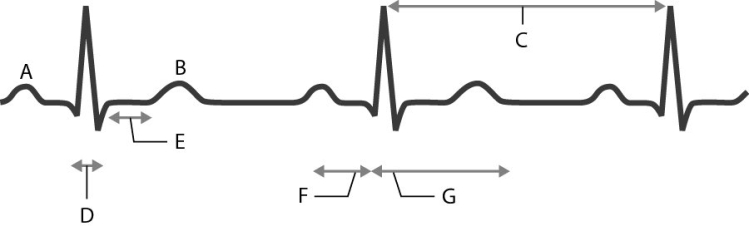 Match the following with the waves, segments, or intervals on the electrocardiogram (ECG).    -Identify the S <sup>-</sup>T segment.