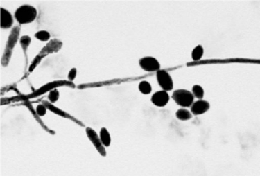  The presence of the specimen shown in the figure in a vaginal discharge is evidence of infection with A)  Trichomonas vaginalis. B)  Treponema palladium. C)  Chlamydia trachomatis. D)  Candida albicans. E)  Neisseria gonorrhoeae.