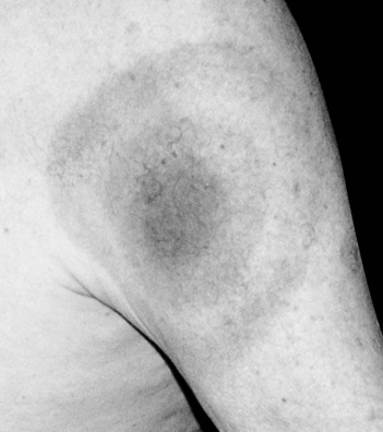   The appearance of this rash is characteristic of infections with which of the following? A)  Epstein-Barr virus B)  Yersinia pestis C)  Borrelia burgdorferi D)  dengue virus E)  Francisella tularensis