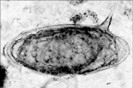   A person reports to a clinic complaining of fever and abdominal pain. The abdomen is swollen, and blood tests indicate kidney damage. A stool sample is examined under a microscope and found to contain the egg shown in the figure. The indications are consistent with infection with A)  Anaplasma phagocytophilium. B)  Trypanosoma cruzi. C)  Toxoplasma gondii. D)  Schistosoma mansoni. E)  Plasmodium falciparum.