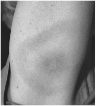   The appearance of this rash is characteristic of infections with which of the following? A) Francisella tularensis B) dengue virus C) Borrelia burgdorferi D) Epstein-Barr virus E) Yersinia pestis