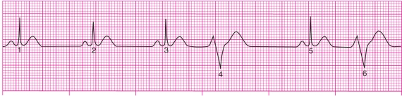 When auscultating heart sounds of a patient, the clinician reports normal beats followed by few abnormal beats.An ECG reveals the following tracing.What is this consistent with? A) Premature ventricular contractions B) Escape rhythm C) Ventricular fibrillation D) Second-degree AV block.