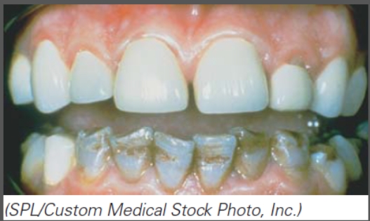 Select the incorrect statement.   A) Chloramphenicol is responsible for the staining of these teeth. B) One can expect the baby teeth and adult teeth to be affected by the antibiotic taken by this individual if consumed by their pregnant mother during the last trimester. C) Tetracycline leads to abnormal bone formation as observed in this image. D) All of these statements are correct.