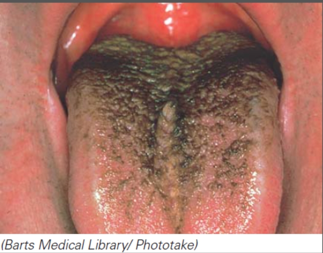 What is happening in this image?   A) The individual is experiencing a side effect from taking an antifungal agent. B) The individual is experiencing a side effect from taking an antibiotic. C) The individual is experiencing a side effect from taking an antiviral agent. D) The individual is experiencing a side effect from taking an antiprotozoan agent. E) The individual is experiencing a side effect from taking an antihelminthic agent.