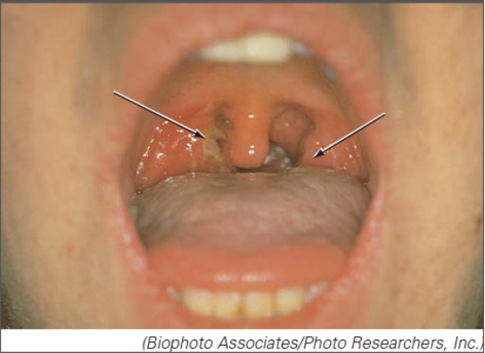 Select the organism responsible for this respiratory tract disorder.   A) Streptococcus B) Haemophilus C) Bordetella D) Neisseria