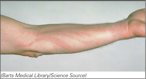 This individual is suffering from _____.   A) subacute endocarditis B) dengue fever C) bartonellosis D) lymphangitis
