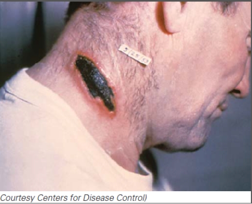 This individual is suffering from:   A) leishmaniasis B) yellow fever C) cutaneous anthrax D) puerperal fever