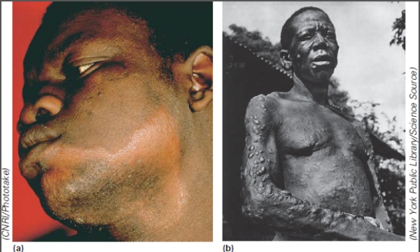 These individuals have:   A) rabies B) West Nile Fever C) tetanus D) polio E) Hansen's disease