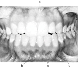 In the following illustration, structure  c  is the   A)  Mucogingival junction B)  Mandibular labial frenum C)  Maxillary labial frenum D)  Mucobuccal fold