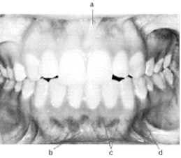 In the following illustration, structure  d  is the   A)  Mandibular labial frenum B)  Mucogingival junction C)  Mucobuccal fold D)  Maxillary labial frenum