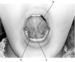 In the following illustration, structure  c  is the   A)  Sublingual fold B)  Sublingual caruncle C)  Lingual frenum