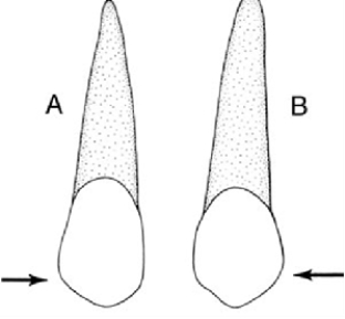In the illustration below, Figure  B  is a   A)  Maxillary central incisor B)  Maxillary lateral incisor C)  Mandibular canine D)  Maxillary canine