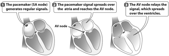 The figure below shows how a pacemaker aids in the regulation of a human heart.   As a result of step 3 in this figure, A)  the atria are in systole. B)  the right side of the heart is in diastole. C)  both the atria and the ventricles are in systole. D)  the ventricles are in systole.