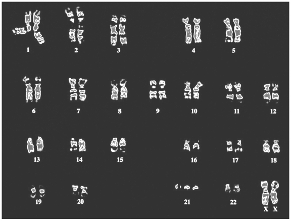 This is the karyotype of an individual with a genetic disorder.   What is the cause of this disorder? A)  The individual has more than one X chromosome. B)  The individual has three copies of one of their chromosomes. C)  The individual has fewer than the normal number of autosomes. D)  Some of the chromosomes of this individual are bent rather than straight.