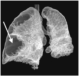 This figure shows a CT scan where the lung on the left is severely impacted by emphysema.   The region indicated by the arrow is clear because A)  a tumor has formed in this region. B)  tar from cigarette smoking is blocking the penetration of X-rays through the lung. C)  the alveoli in this region have all ruptured as a result of exposure to the irritants from cigarette smoke. D)  fluid has accumulated in this region of the lung as a result of edema.